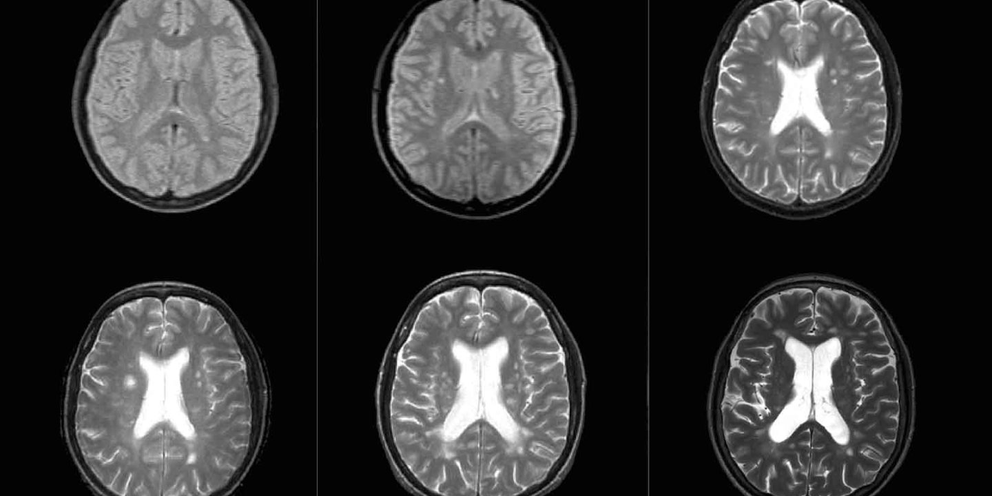 an image of 6 brain scans in black and white