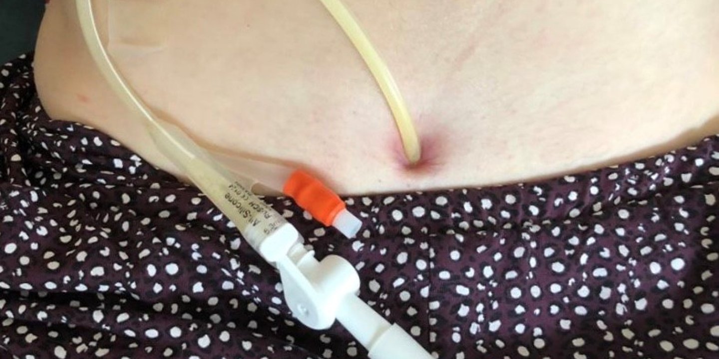 Close up of a suprapubic catheter