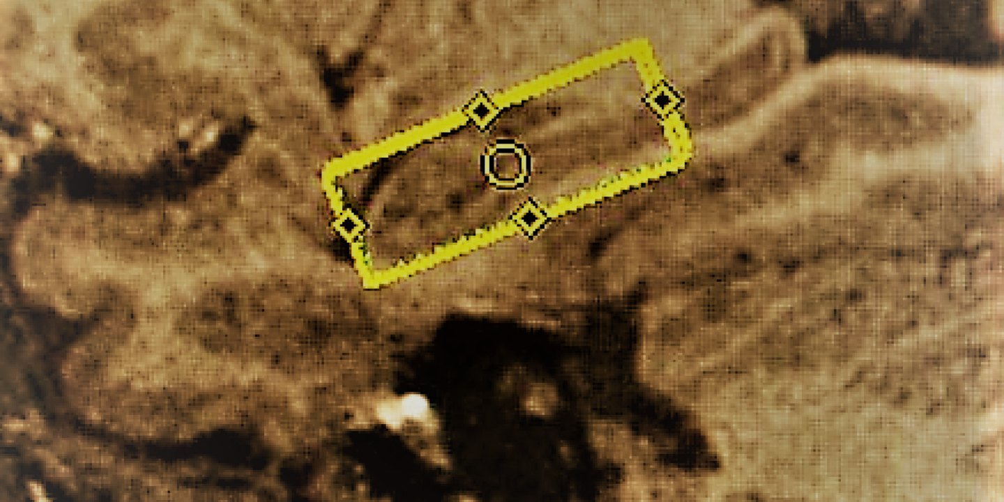 MRI picture of one of the new imaging techniques used to assess inflammation of the hippocampus