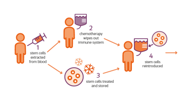 infographic shows HSCT stages, how stem cells are extracted and reintroduced after chemotheraphy is used to wipe out the immune system