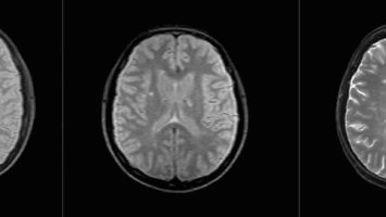 A black and white Scan of a brain 