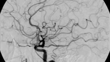 Black and white microscopic image of veins