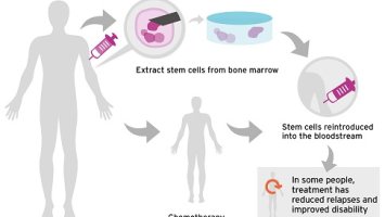 Diagram of stem cell treatment