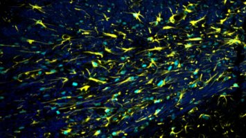 This image shows active astrocytes (yellow) in a mouse brain with damaged myelin (dark blue).