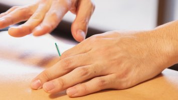 acupuncture being performed on a person's back