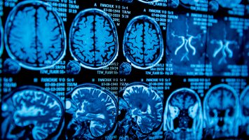 The photo shows multiple brain scan images on a screen
