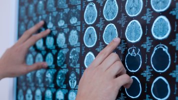 The photo shows brain scans being pointed at on a board