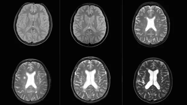 an image of 6 brain scans in black and white