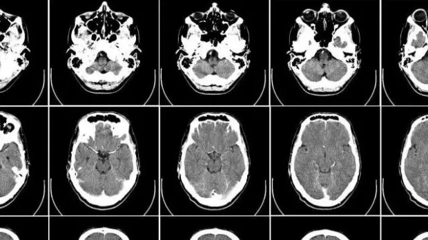 a black and white image of Brain scans