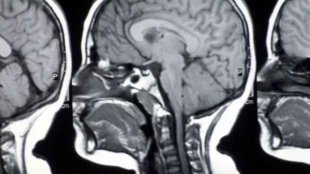 An MRI scan showing a cross section of the brain