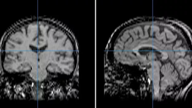 Image shows an MRI scan from 2 angles