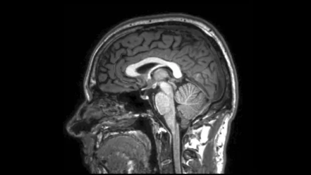 mri scan of the brain