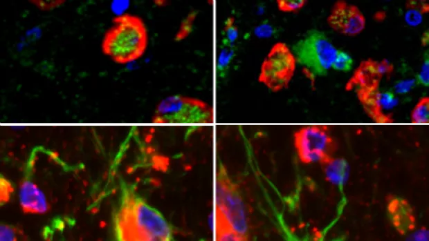 Image shows immune cells in MS