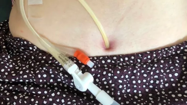 Close up of a suprapubic catheter