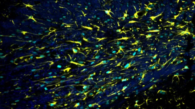 This image shows active astrocytes (yellow) in a mouse brain with damaged myelin (dark blue).