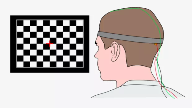 A drawing of the visual evoked potential test by Chris McMurran. A person is looking a screen with nerve sensors placed on their head.
