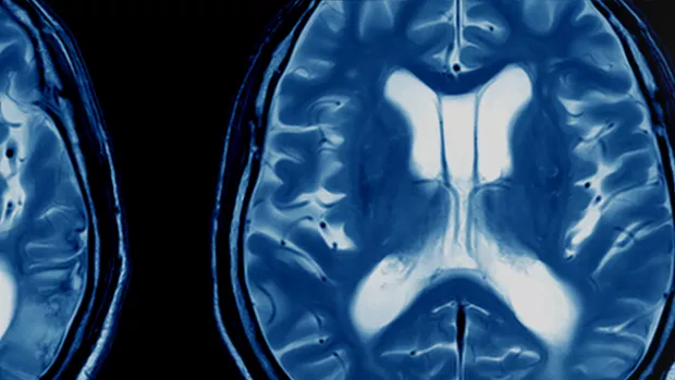 Banner shows a brain in MRI with the words STOP MS next to it