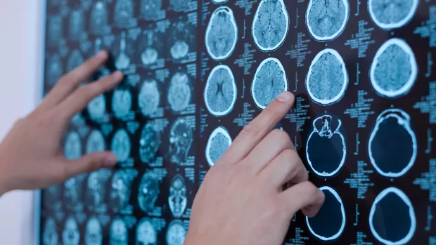 The photo shows brain scans being pointed at on a board