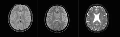A black and white Scan of a brain