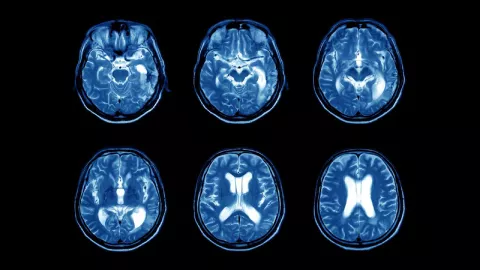 MRI scans of a brain
