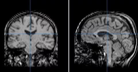 Image shows an MRI scan from 2 angles