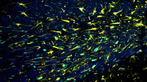 This image shows active astrocytes (yellow) in a mouse brain with damaged myelin (dark blue).
