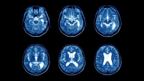 MRI scans of a brain