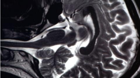 Image shows an MRI scan
